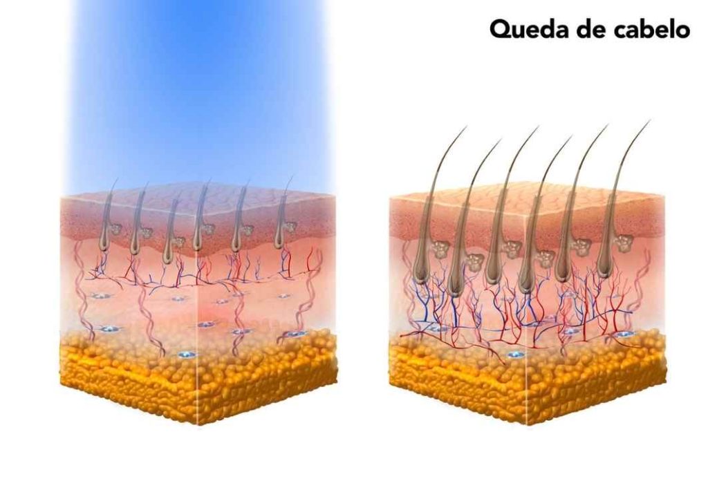 Queda Capilar tratamento com fotobiomodulação - Estética IBRAMED