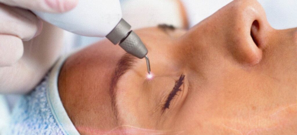Blefaro com jato de plasma