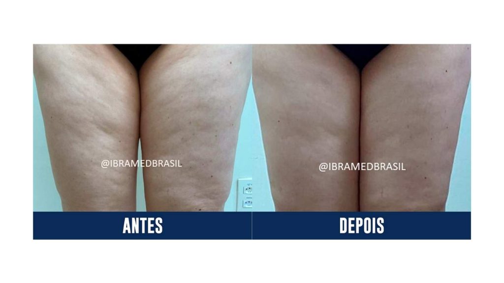 Radiofrequência associado a Vacuoterapia para celulite - Ibramed - Dermothonus Esthetic