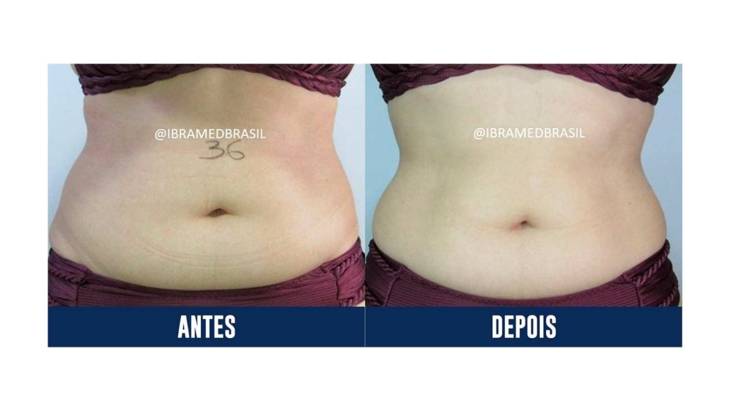 Neartek para Gordura Localizada - Tecarterapia IBRAMED