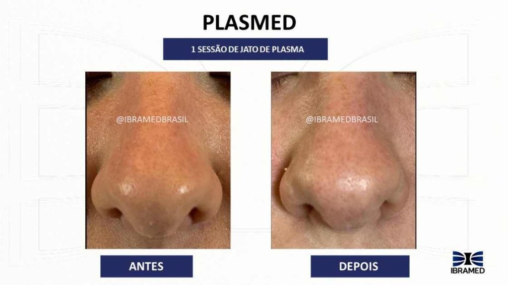 Antes e depois de procedimento com Jato de Plasma para afinamento do nariz