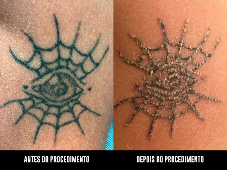 Remoção de tatuagem com laser NdYag Q-Switched
