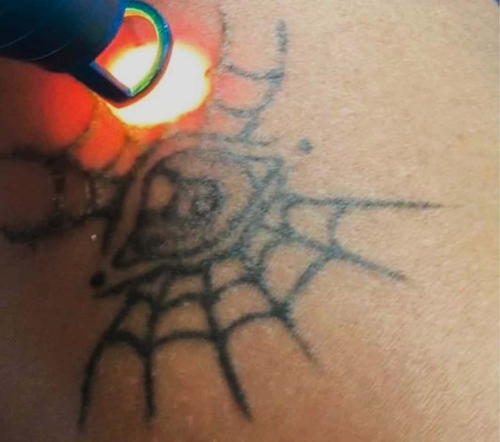 Remoção de tatuagem com Laser - Syrius IBRAMED