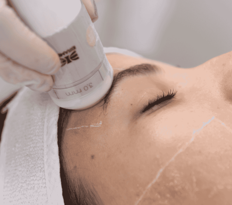 Harmonização Orofacial com Ultrassom Microfocado - Tendências para 2025
