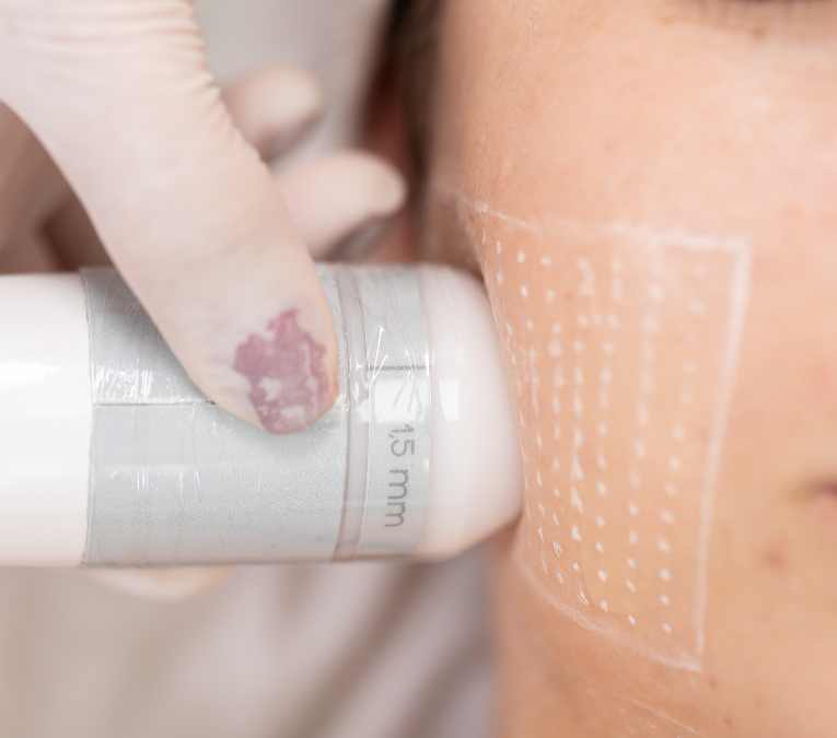 Ultrassom Microfocado - Tendência na área estética 2025 - Guia completo de Ultrassom Microfocado hifu