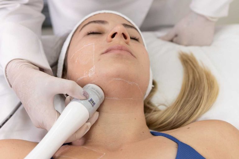 Ultrassom Microfocado para redução de papada - Estética Facial