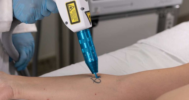 Syrius Yag para Remoção de Tatuagem ibramed