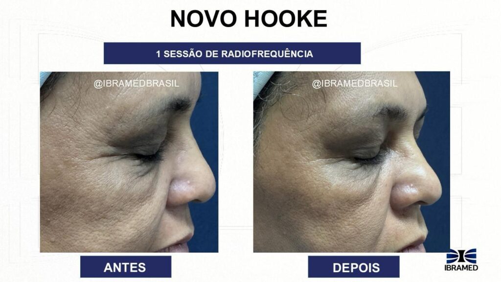 Hooke Radiofrequência 27,12 MHz