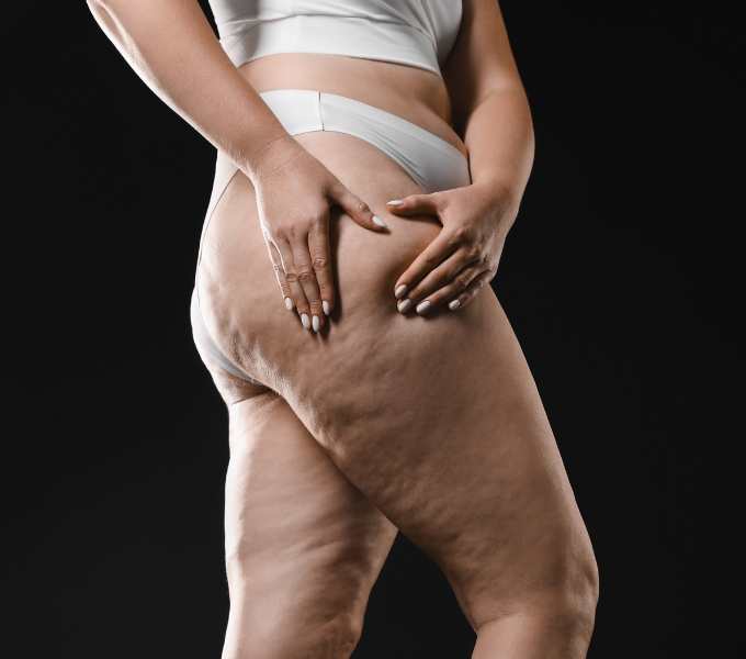 Junho, mês de conscientização do lipedema