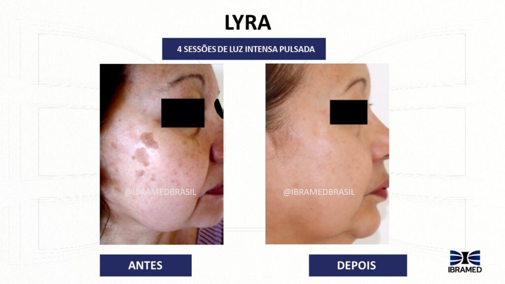 Lyra Ibramed Luz Intensa Pulsada