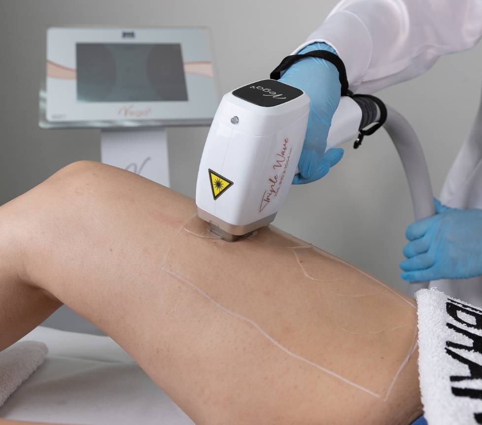 Laser de Epilação Vega - Laser Triple Wave Ibramed