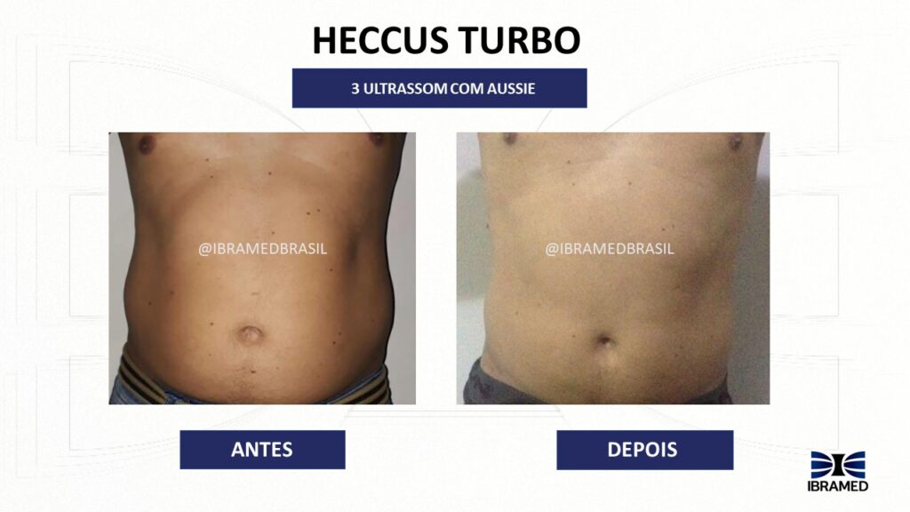Heccus Turbo