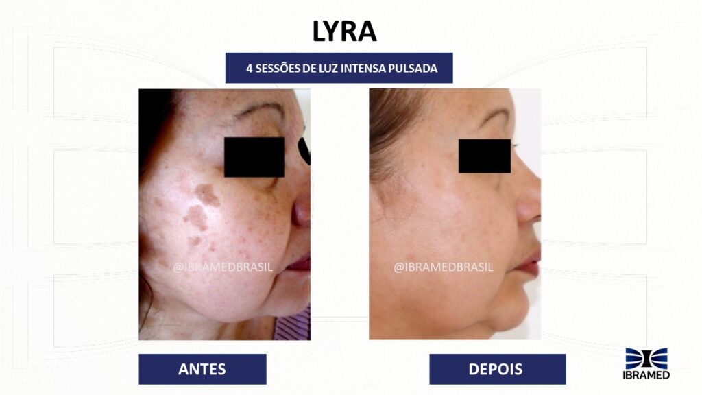 Luz Intensa Pulsada para Manchas antes e depois com o Lyra da Ibramed