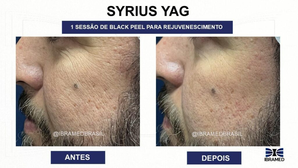 Syrius YAG – Laser Nd:YAG Q-Switched para Black Peel - Antes e Depois