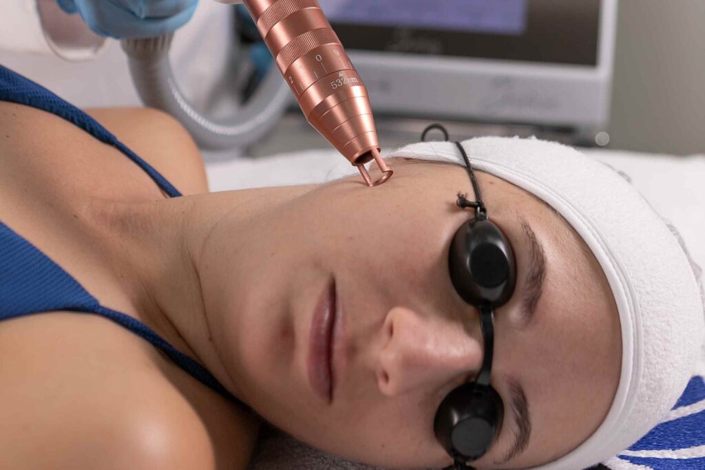 Laser Nd:Yag Q-Switched para harmonização orofacial HOF - Rejuvenescimento Facial