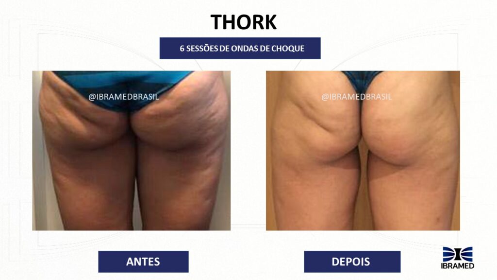 Antes e depois de ondas de choque para celulite