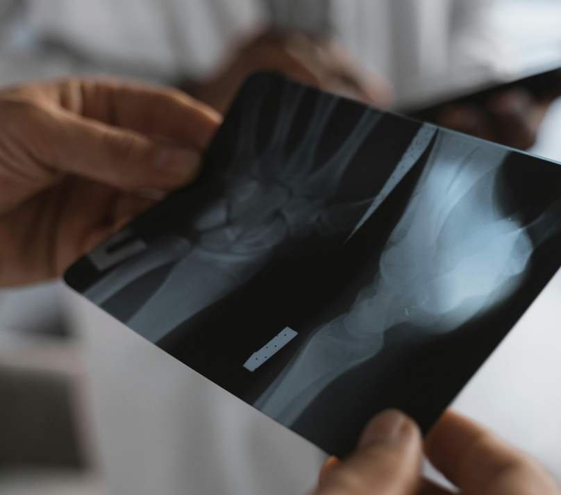 Utilização de Ultrassom Terapêutico para fraturas