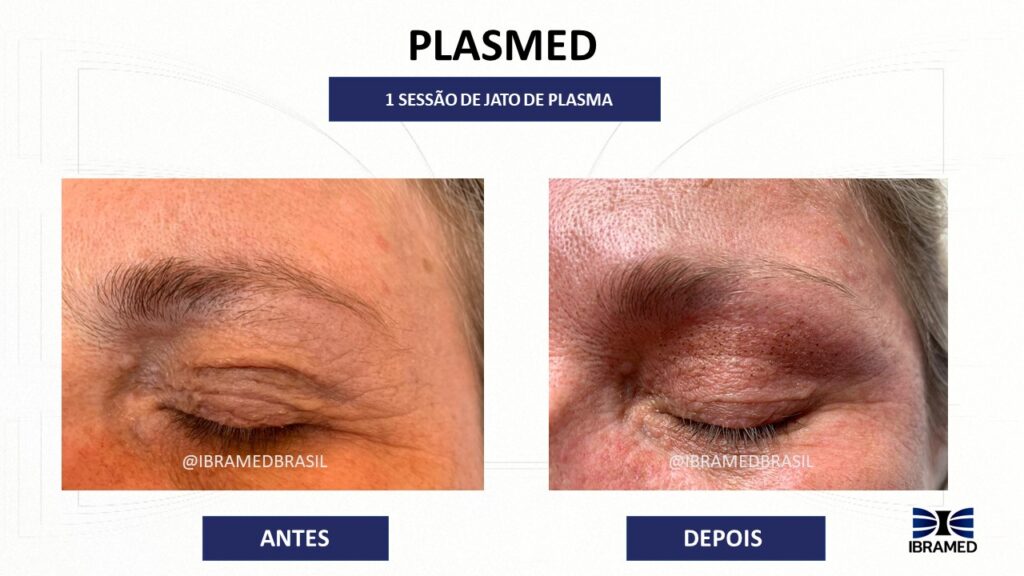 Antes e depois de Blefaro sem Cortes com Jato de Plasma Plasmed Ibramed
