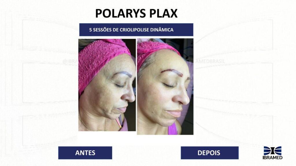Criolipólise de Placas com Microcorrentes para tratamento de Flacidez - Antes e Depois