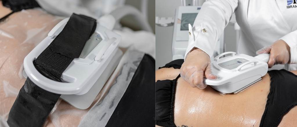 Criolipólise de placas estático e dinâmico com o Polarys Plaxx