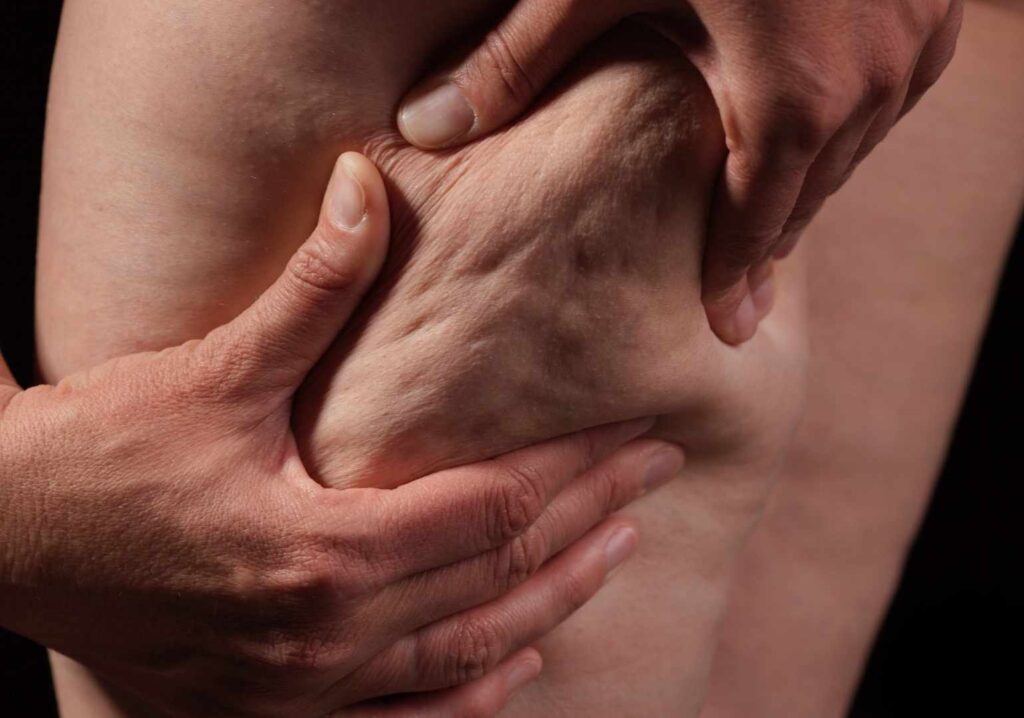 Lipedema