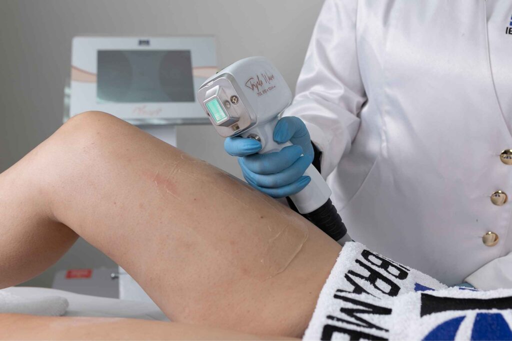 Epilação a Laser com o Vega Laser Triple Wave para estudo científico de remoção de pelos