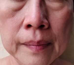Rosto de Ozempic: como a estética pode ajudar