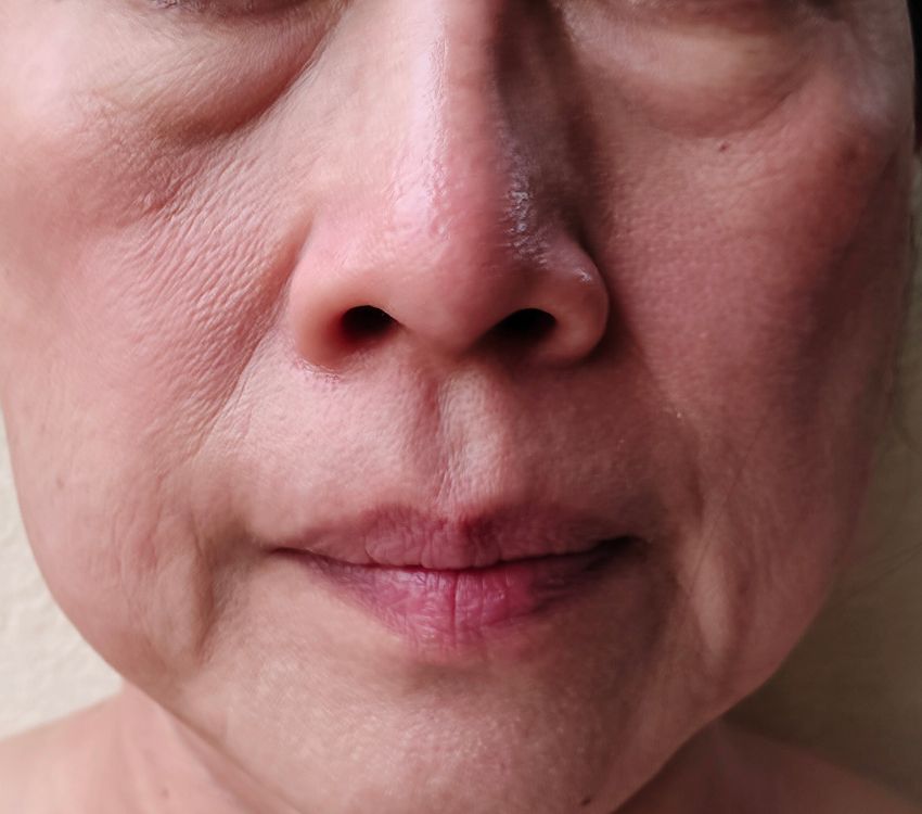 Rosto de Ozempic: como a estética pode ajudar