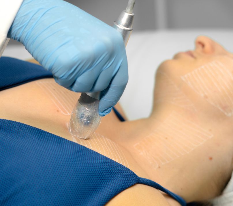 Estética Regenerativa ultrassom microfocado