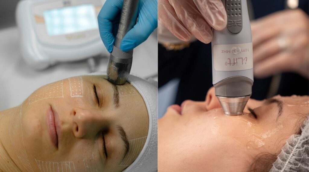 Ultrassom Microfocado associado a Ultrassom Terapêutico Facial para lifting