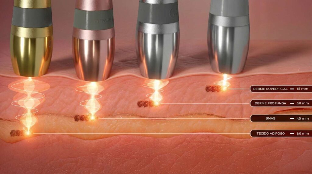 Ultrassom Microfocado Visage Fisiologia - Ibramed