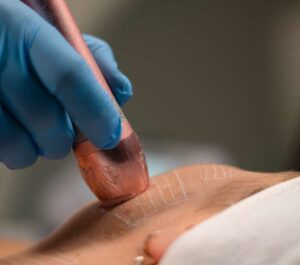Ultrassom Microfocado Visage Ibramed