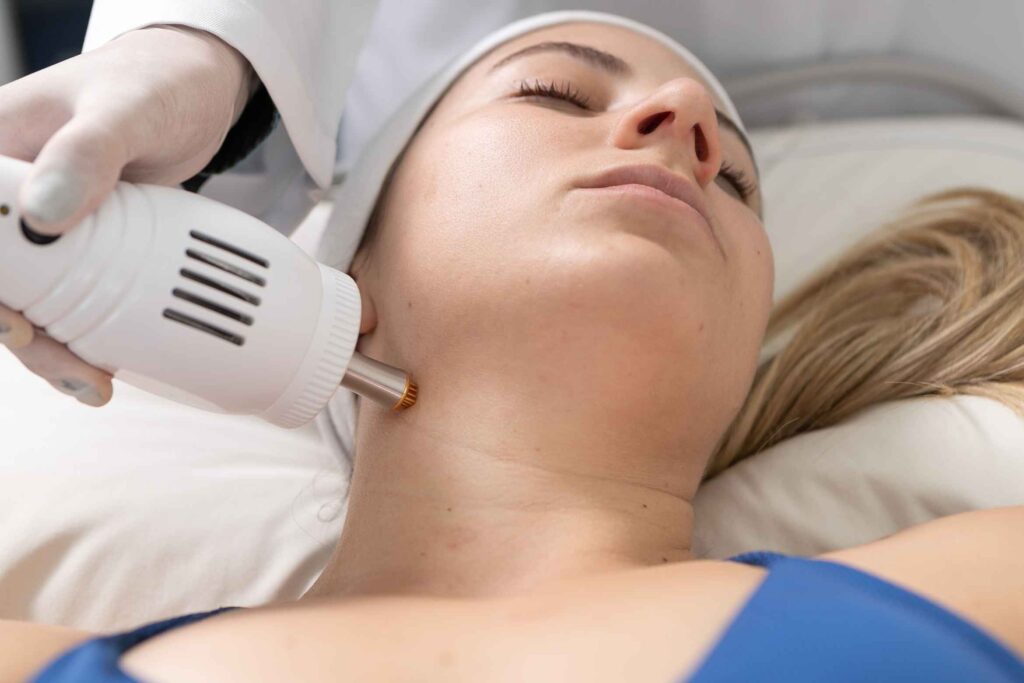 Criofrequência Fracionada para flacidez e rejuvenescimento