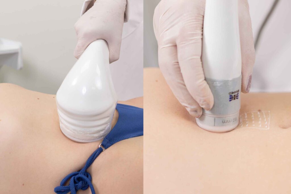 Sonofocus Ultrassom Microfocado e Macrofocado
