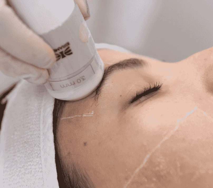 Harmonização Orofacial com ultrassom microfocado
