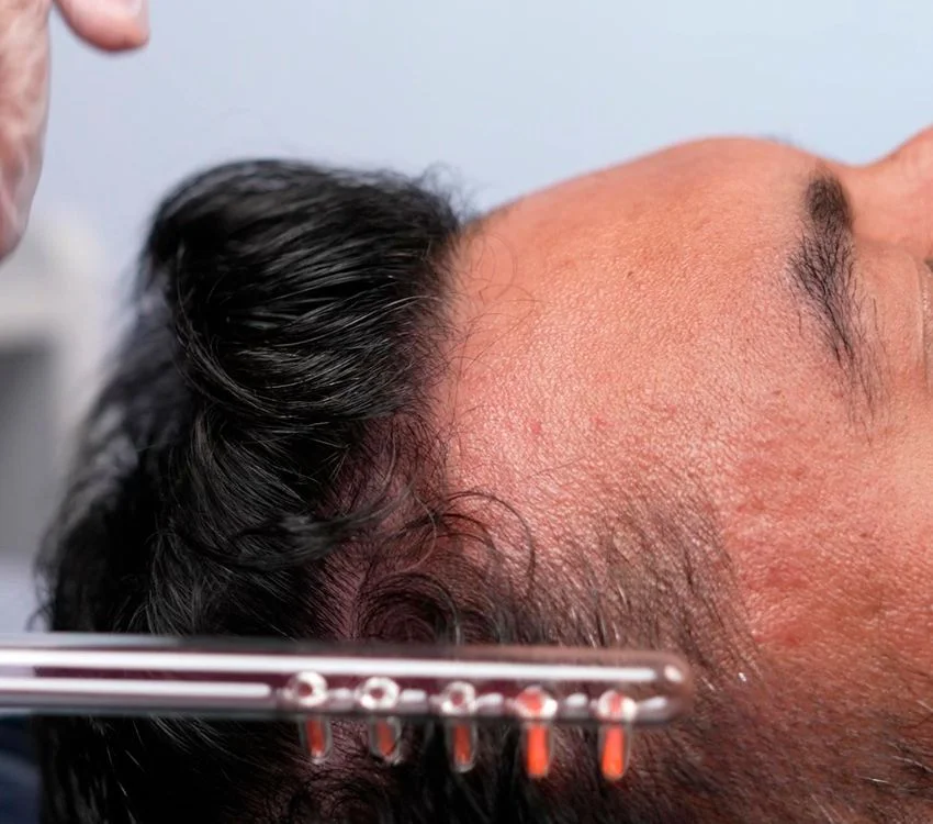 Alta Frequência HF Ibramed para terapia capilar
