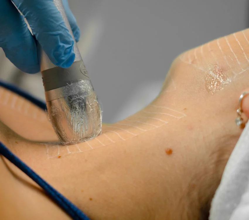 Ultrassom Microfocado para rejuvenescimento - Visage Ibramed
